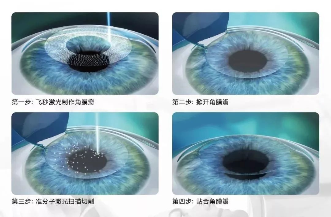 半飞秒和全飞秒有什么区别？